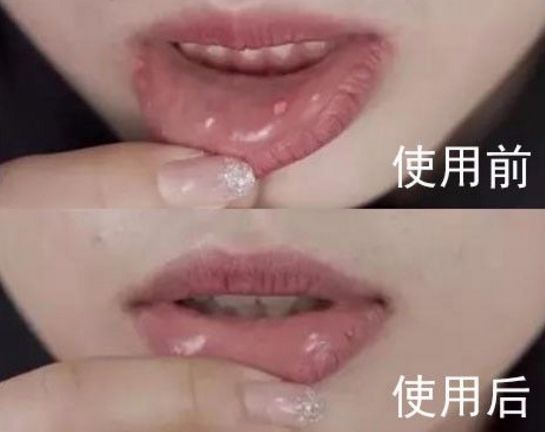 牙龈肿了出血口臭牙黄用什么牙膏,牙龈上火牙膏