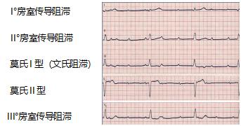 心动过缓不要慌,心脏起搏器来帮忙