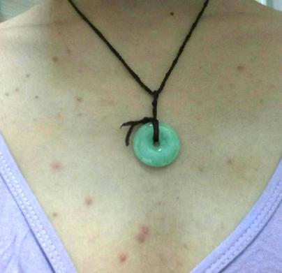 前胸后背都长痘痘全是黑印,背后有痘痘可以穿露背装吗