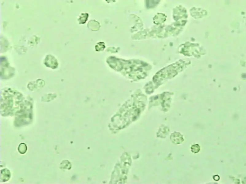 尿液中有肉眼可见杂质正常吗,尿液有形成分检查细菌偏高