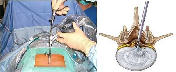 骨科微创手术动画,背部骨科微创手术