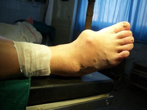 痛风适合运动健身么,痛风了适合跑步吗