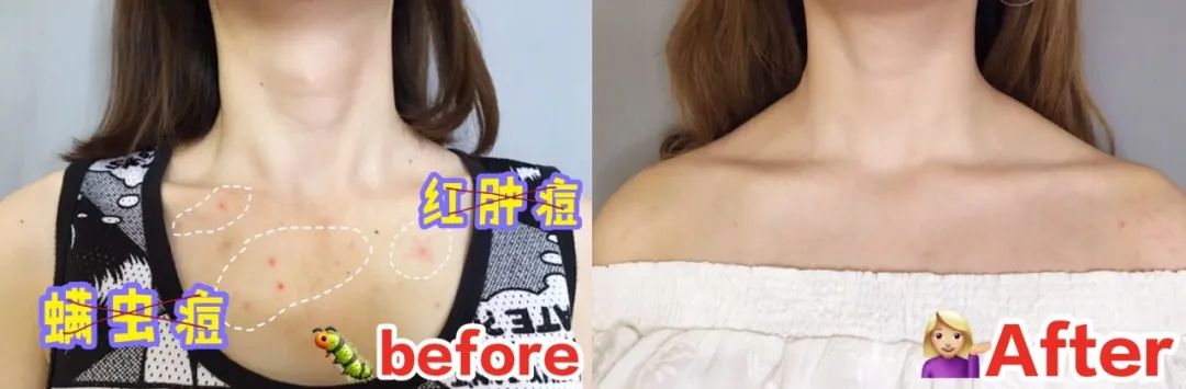 啤酒消痘痘,喝啤酒会消除痘痘吗