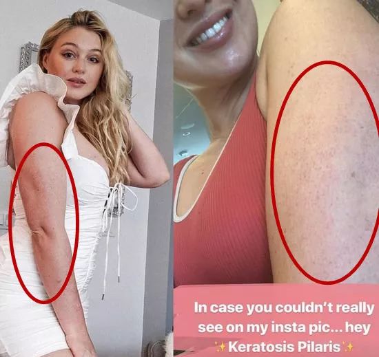 别放弃，烦人的“鸡皮疙瘩”，真的还可以再救一下