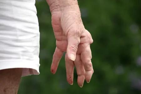 教你4招轻松应对风湿性关节炎痛,用什么方法缓解风湿