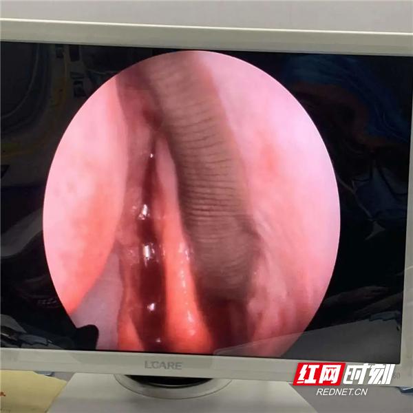 男子咳血4年竟是蚂蟥寄居鼻腔中,女子咳血后发现体内竟有蚂蝗