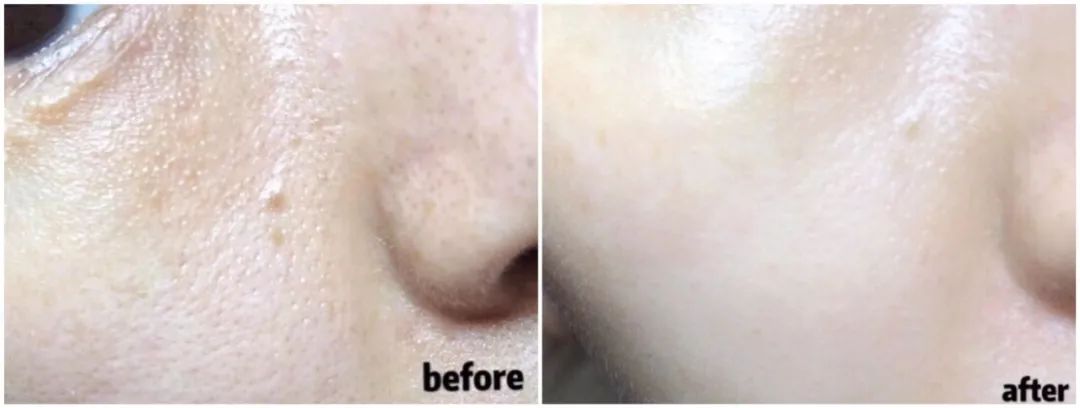 清洁毛孔黑头粉刺吸尘器,doco超微小气泡毛孔吸尘器直播