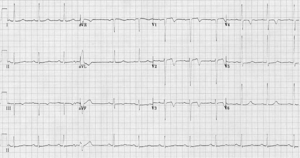 心肌缺血的心电图图解,心肌缺血的典型心电图图片