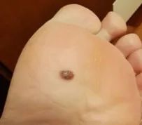 容易癌变的痣去哪里切除,从小就有的痣要切除吗