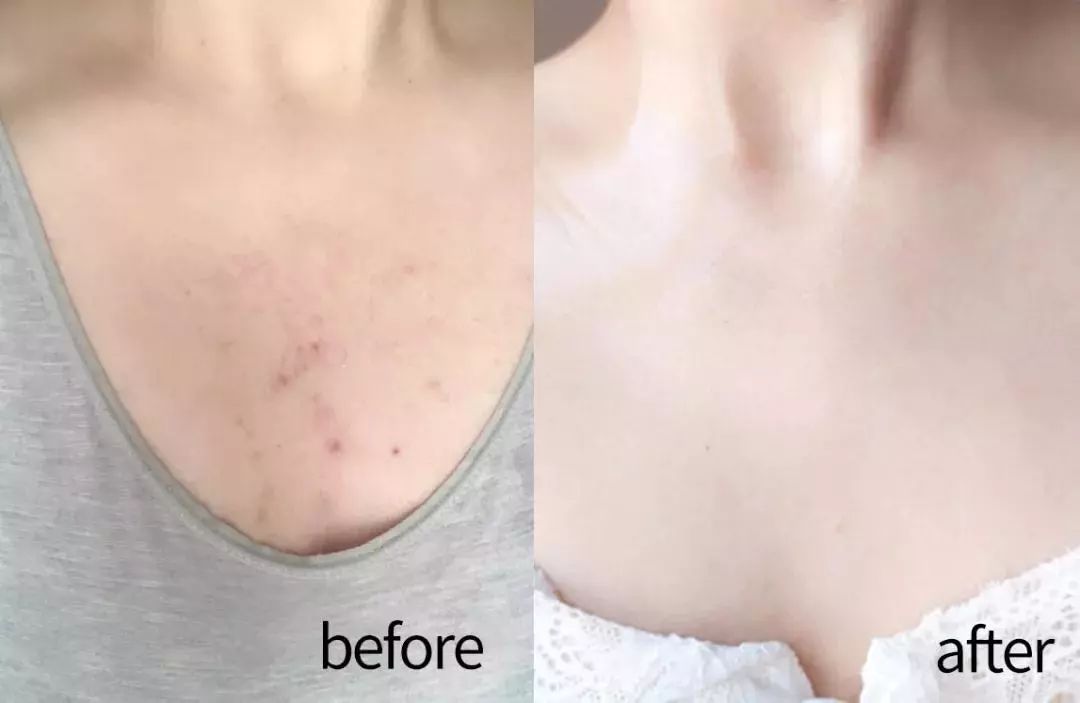 挤痘痘出来的白色长条状是什么,痘痘黑头挤出白颗粒