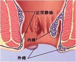 超声多普勒引导下痔疮手术多少钱,超声多普勒治疗痔疮优缺点