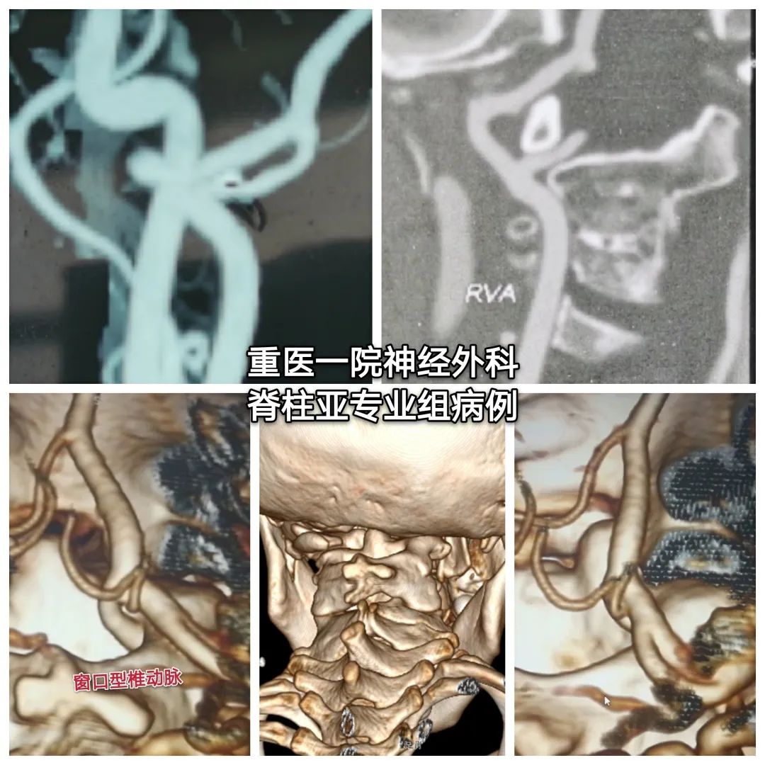 寰枢椎半脱位与痉挛性斜颈,寰枢椎发育畸形