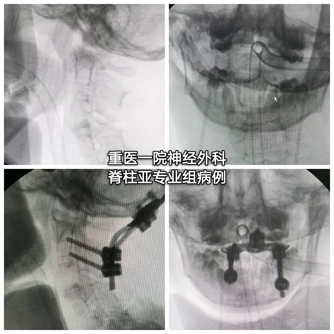 寰枢椎半脱位与痉挛性斜颈,寰枢椎发育畸形