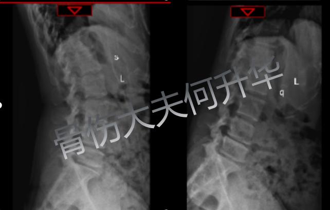 【谈骨论筋】我的腰椎做了微创手术为什么还会痛？一文带你了解术后疼痛原因及防治方法