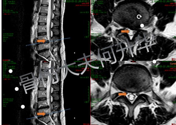 【谈骨论筋】我的腰椎做了微创手术为什么还会痛？一文带你了解术后疼痛原因及防治方法