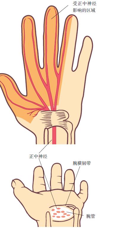 腕管综合征的诊断要点是,腕管综合征诊断标准mr