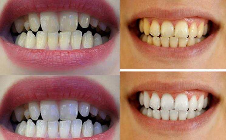 牙齿变黄你真的刷对了吗,牙齿黄了怎么办不用花钱去洗牙