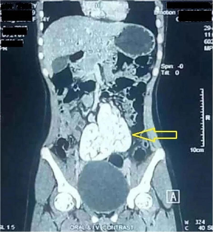 融合肾盏,融合肾与重复肾的区别