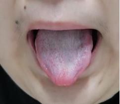 新冠病毒中医方案,新冠少阳辨证