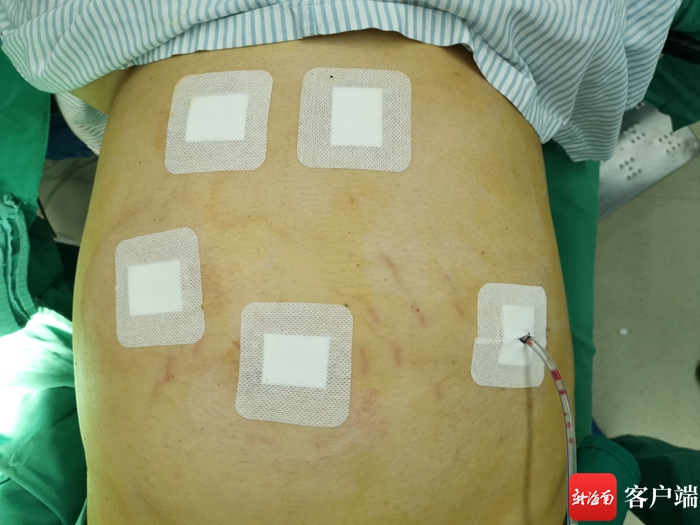 做糖尿病手术体重130斤还用切胃吗,糖尿病110斤可以做切胃手术吗