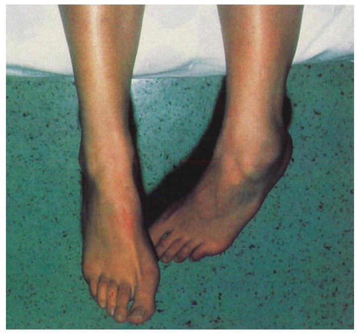 踝关节损伤的处理7条助你应对,踝关节韧带损伤多久能恢复正常