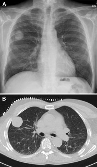 50多岁胸部有硬块疼痛是什么病,老人乳房有肿块胸腔痛