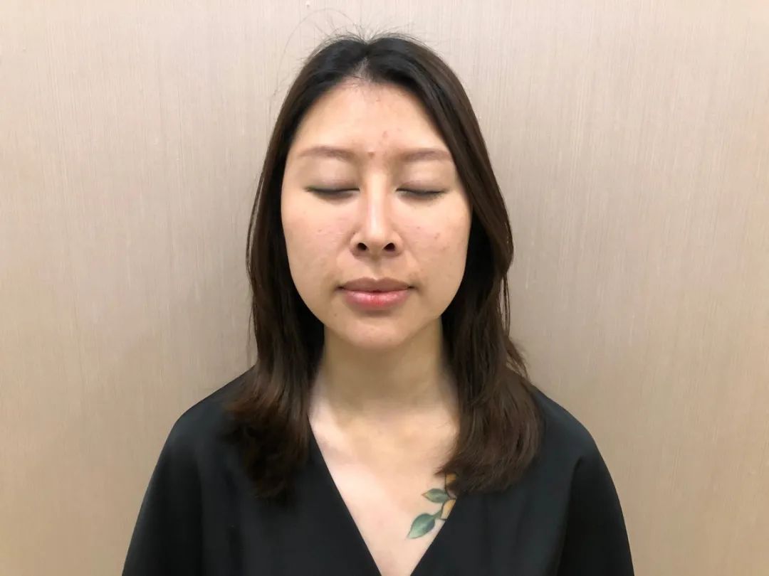 网红热玛吉效果怎么样,5代热玛吉美白