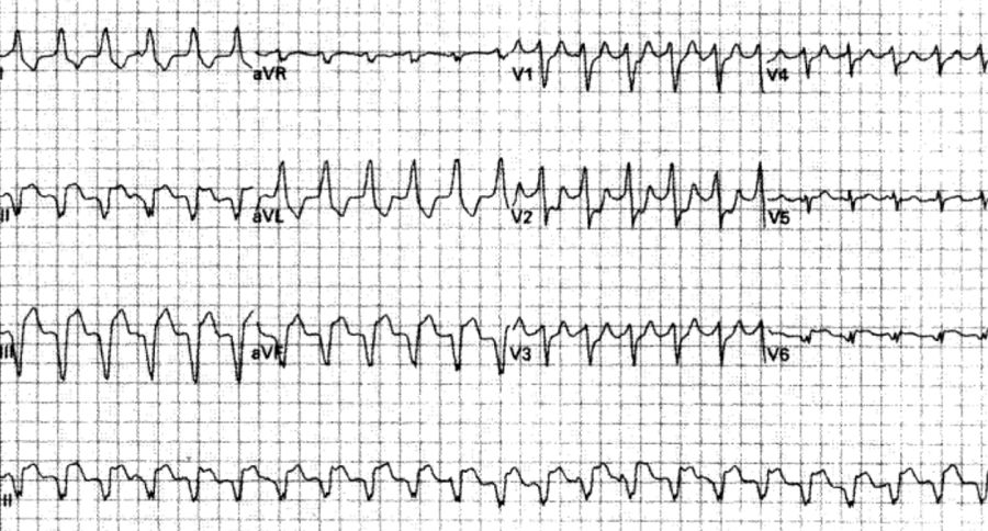 室速属于重大疾病吗,室速的相关资料