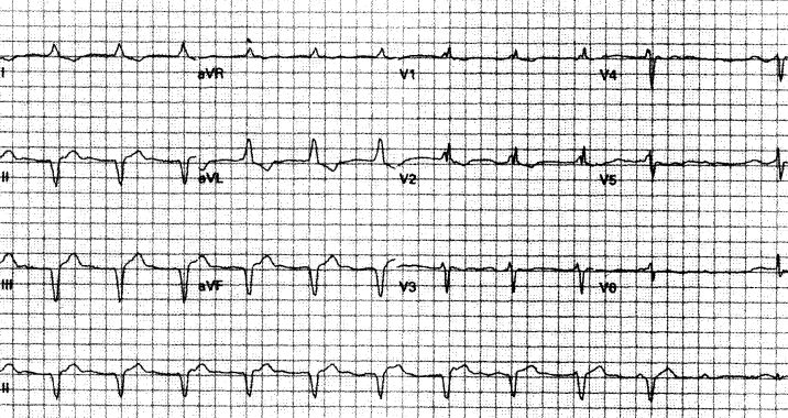 室速属于重大疾病吗,室速的相关资料