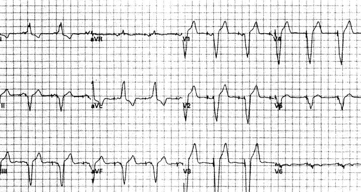 室速属于重大疾病吗,室速的相关资料