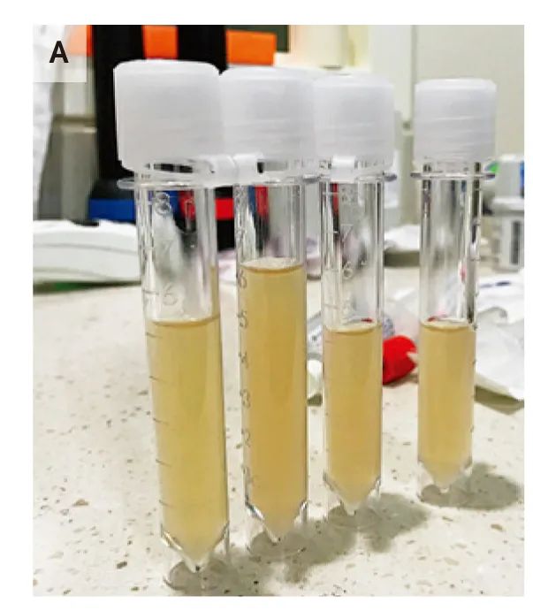游泳得脑膜炎,游泳发烧会引起脑损伤吗