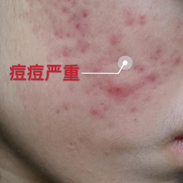 祛痘痘痘印最有效的国货产品,老国货治痘痘