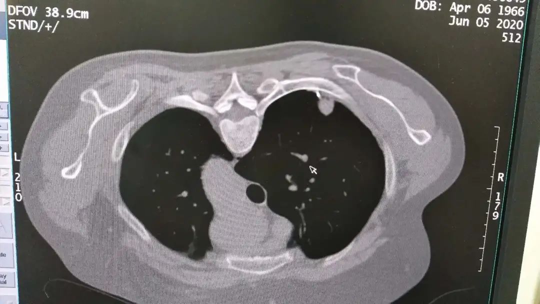 这项自主研发的新技术，能帮肺肿瘤患者快速诊疗