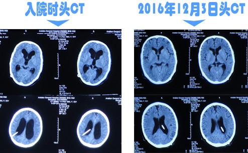 脑积水腹腔分流术后头晕头痛,脑积水分流术后发烧会有什么后果