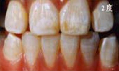 地方病防治宣传核心信息—碘缺乏病、包虫病、地方性氟中毒