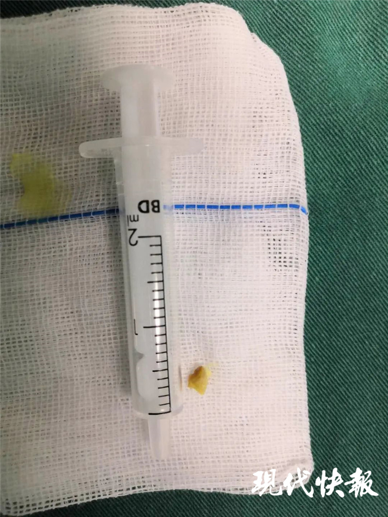 小孩子吃板栗加重咳嗽怎么办,宝宝吃板栗呛到了的喘声是什么样