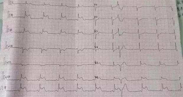 34岁北大博士心梗猝死,国世平老师突发心梗