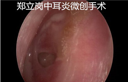 乳突炎中耳炎要做耳内镜吗,中耳乳突炎耳内镜手术