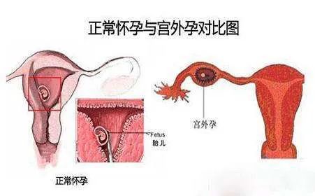 人体取出的节育环,体内节育环30年了还能取吗