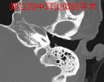 中耳炎耳内镜微创手术,内镜微创中耳炎