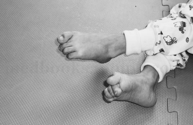 婴幼儿脑瘫早期发现和早期治疗直接影响今后生活质量