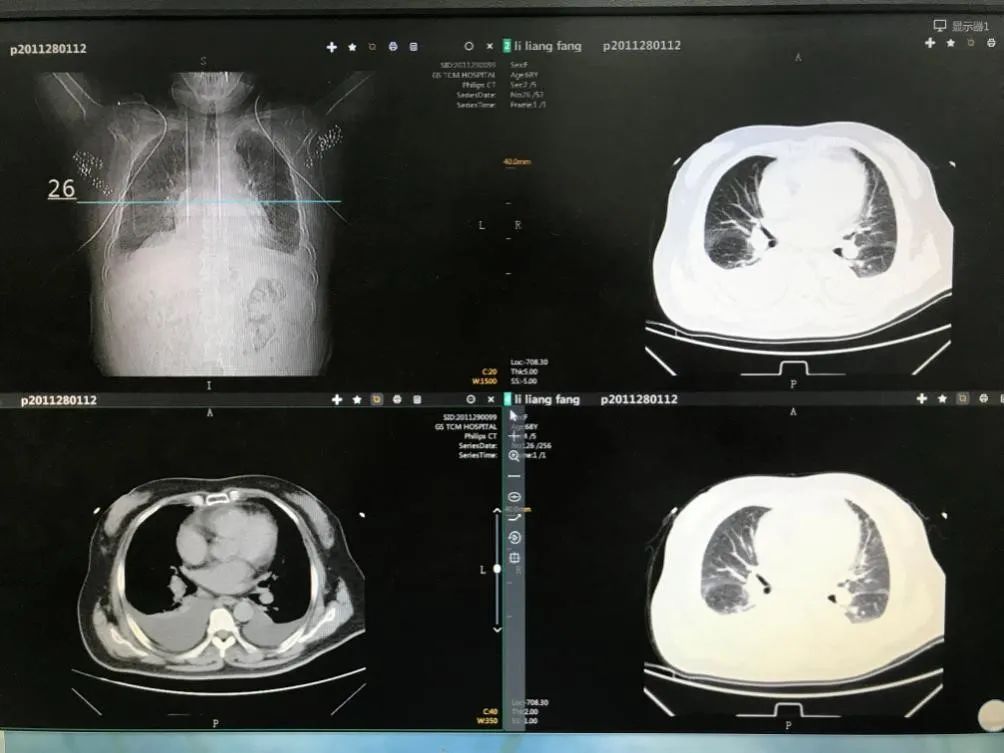 心力衰竭的胸腔积液有办法治疗吗,心力衰竭造成胸腔积液能治好吗