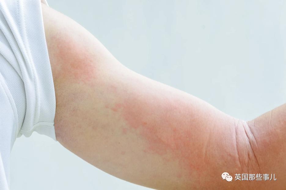 第一次过敏身上起麻疹怎么回事,运动会引起荨麻疹反反复复出现吗