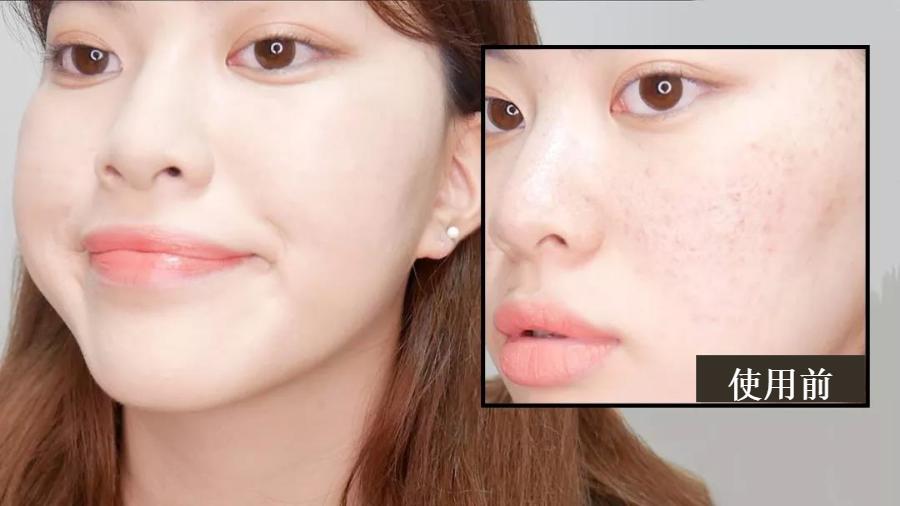 花了3万做激光,才彻底懂了:医生为什么劝你别去斑