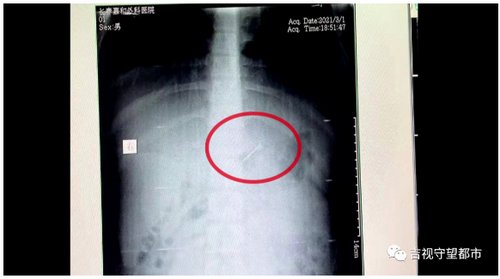 误吞4厘米钢钉，13岁“熊孩子”被紧急送医