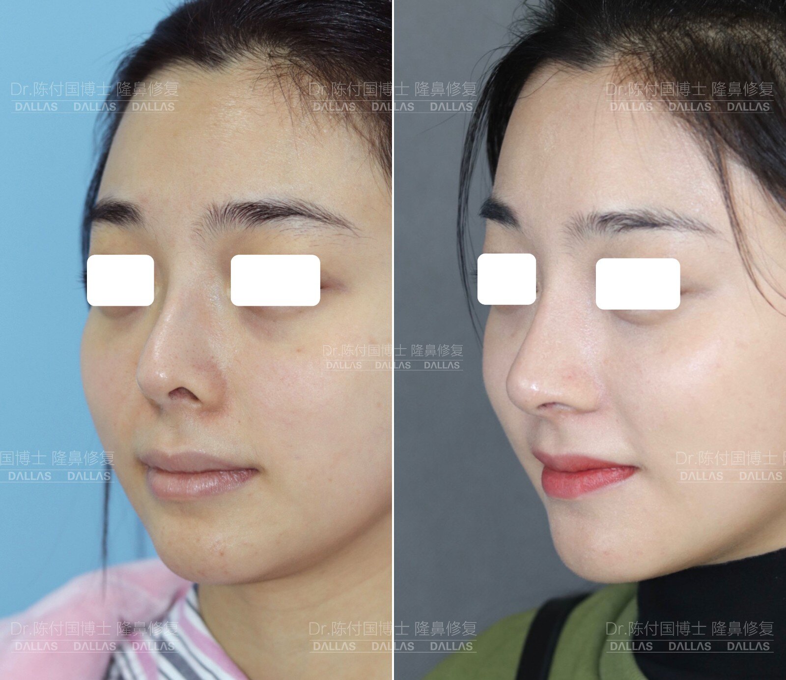 隆鼻鼻尖显形露鼻孔怎么修复,隆鼻修复微驼峰