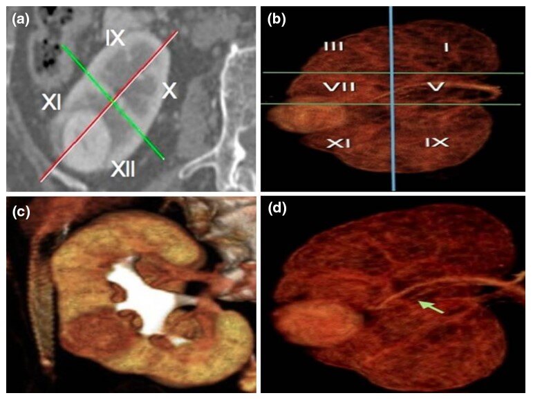 目前治愈肾癌的最好方法,早期肾癌的最新治疗方法