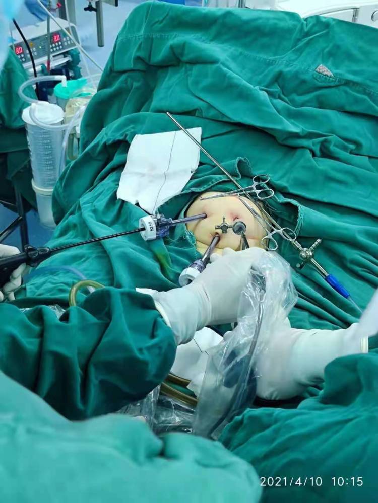 腹腔脏器修补术有哪些,腹腔探查手术戳孔位置