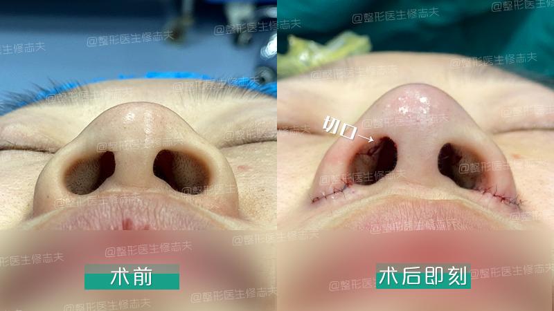 鼻综合整形切口,鼻综合切口处愈合几率