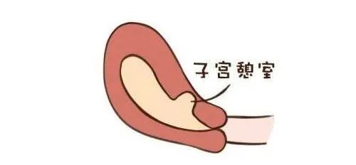 珠江妇幼子宫疤痕憩室,子宫疤痕憩室怎么改善经期长